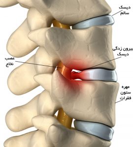 دیسک و ستون فقرات