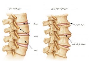 دیسک و ستون فقرات